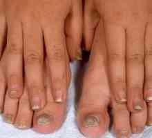 Средства за гъбички за ноктите на краката: лечение и профилактика