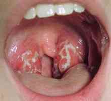 Стрептококи в гърлото: признаци, причини и лечение