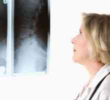 Подхондрална склероза на гръбначния стълб - какво е това и какви са причините?