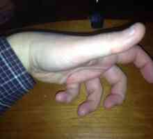 Slylo пръст на ръката: причини, лечение и превенция