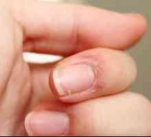 Пропуква кожата на пръстите в близост до ноктите: причините и лечението. Празна кожа на пръстите на…