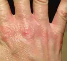 Крекинг кожата на пръстите: причини, лечение