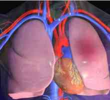 Тромбоемболизъм на малките клони на белодробната артерия: причини, симптоми и диагноза
