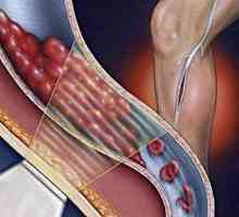 Тромбоемболизъм на долните крайници: възможни причини, симптоми и характеристики на лечението