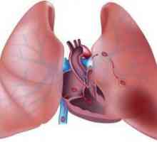 Тромби в белите дробове. Тромбоемболизъм на белодробната артерия: причини, симптоми, ефекти, лечение