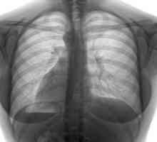 Туберкулоза на гръбнака: причини, симптоми, лечение