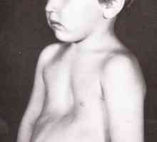 Детето има деформация в гръдния кош: причините за патологията и методите на лечение