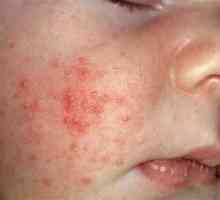 Дали детето има изпотяване или алергия? Как да разграничаваме.