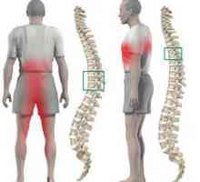 Премахване на херния на гръбначния стълб: индикации, рехабилитация, последствия, прегледи
