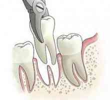 Отстраняването на корена на зъба е сложна, но най-безболезнена процедура