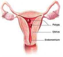 Отстраняване на полипа в матката: прегледи. Следоперативен период