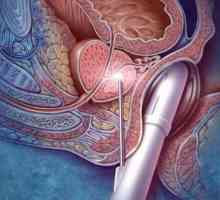 Премахване на простатата: последици от операцията, прегледи