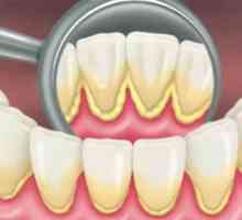 Отстраняване на плаки: професионално почистване на зъбите