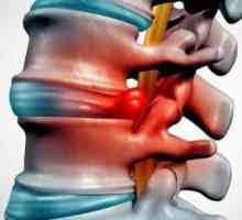 Инжекции в хернията на лумбалната част на гръбначния стълб: списък на лекарствата, препоръки на…