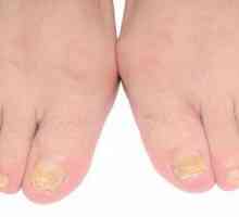 Оцет от ноктите на ноктите на краката: рецензии, характеристики на приложението и ефикасност