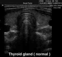 Ултразвукът на щитовидната жлеза е нормален. Размерът на щитовидната жлеза е нормален. Индикатори…