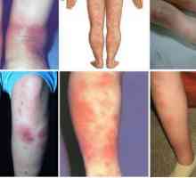Нодуларен еритем по краката: симптоми, причини, лечение