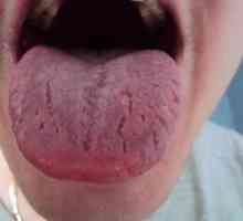 Какво причинява изгаряне на езика?