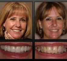Връщането на красива усмивка ще помогне за постоянната протекция на зъбите