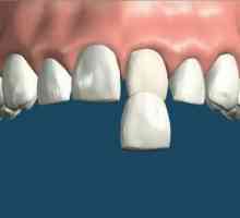 Фурнир върху зъби: предимства на елемента, характеристики на неговата инсталация и указания за…