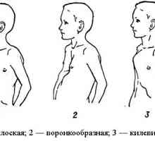 Деформация на гръдния кош във формата на фуния: причини, симптоми, диагноза и лечение