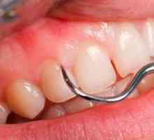 Възпаление на венците близо до зъба на мъдростта. Как да облекчим гингивита у дома