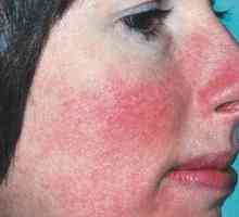Възпаление на кожата на лицето: причини, видове, превенция и лечение