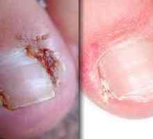 Отглеждане на ноктите на крака: причини за появата и лечението