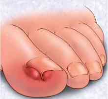 Вградени нокти на краката: причини, симптоми, лечение