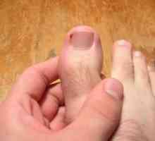Вграден нокът на краката: снимка, причини, методи на лечение