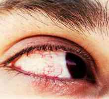 Избухвания в очите: причини, симптоми