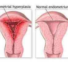 Остъргване на ендометриална хиперплазия: признаци, признаци и последствия
