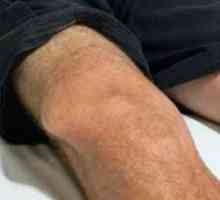Разместване на колянната става: основни симптоми, лечение