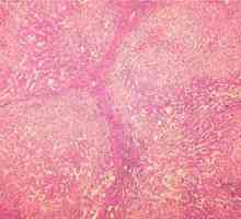 Болест на чернодробна цироза: колко живеят с нея