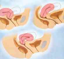 Огъване на матката: причини, симптоми, характеристики на лечението и последици