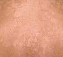 Жълти петна по кожата: причини