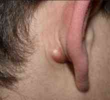 Zhirovik зад ухото: възможни причини за появата и особеностите на лечението