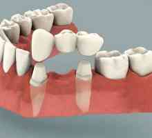 Зъбният мост: рецензии. Монтаж на стоматологичен мост