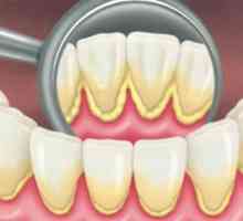 Депозити на зъби: видове, причини и методи за изхвърляне