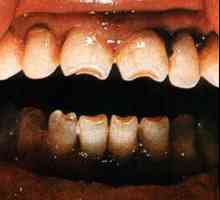 Зъбите на Гецшинсън: причини, описание на формата и структурата, снимка