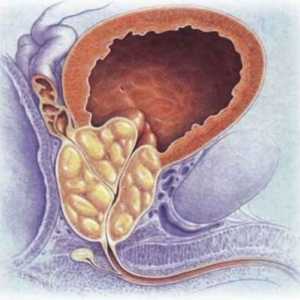 Какво представлява простатната аденома? Белодробна хиперплазия на простатата