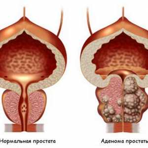 Аденом на простатата: симптоми, лечение, операция