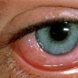Алергичен конюнктивит: характеристики на курса и лечение