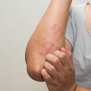 Алергии към кожата: възможни причини, симптоми и характеристики на лечението