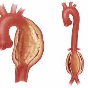Аневризма на аортата на сърцето - какво е това? Аневризма на аортата: причини, симптоми, лечение