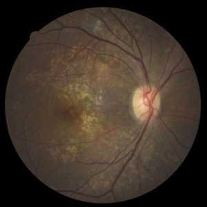 Агиоскероза на ретината - какво е това? Какво е опасно за хипертония?