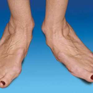 Артрит на краката: лечение и причините за появата