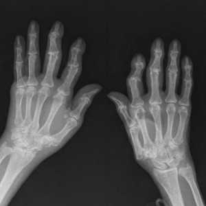 Артроза на ръцете: лечение, симптоми и причини