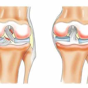 Остеоартрит на колянната става: лечение в дома. Лечение на артрозата на козметичните средства за…
