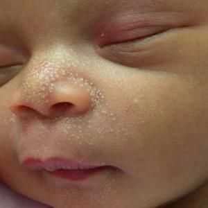 Бели точки на носа на новороденото. Защо новороденото има бели точки на носа? Кога преминават…